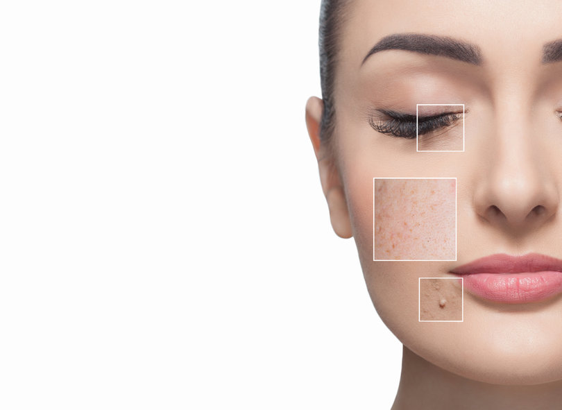 L’acné est un motif de consultation très fréquent : il touche près de 70 % des adolescents.